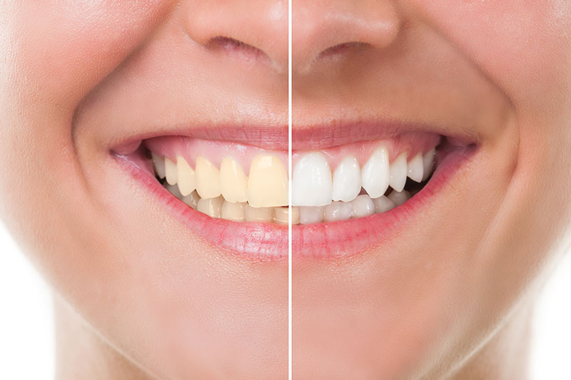 Teeth Whitening in Sacramento